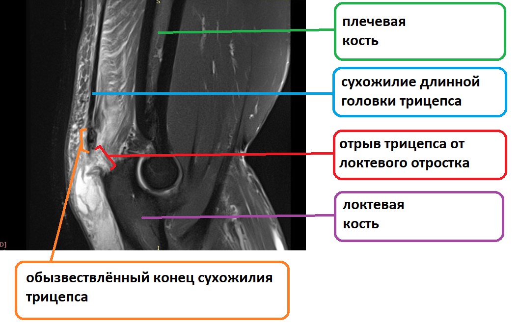 Тендинит трицепса: причины, симптомы, лечение и профилактика